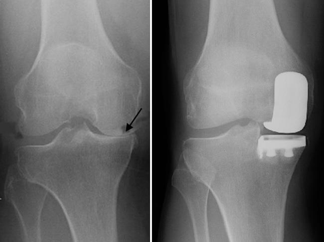 X-rays of a good candidate for partial knee replacement
