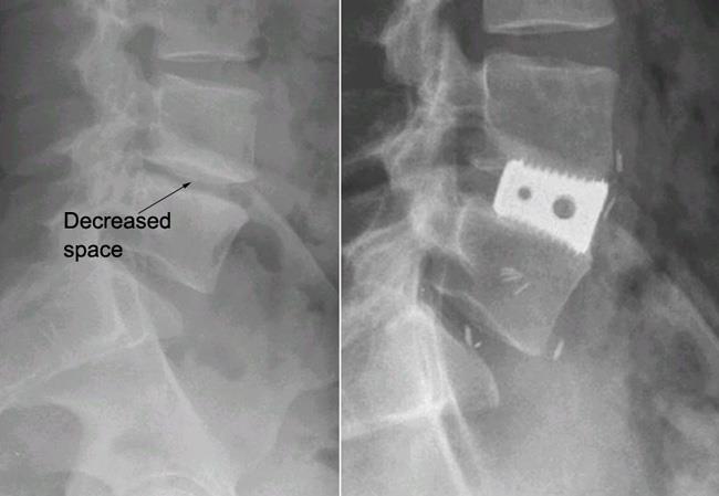 x-ray of decreased disk space and inserted interbody cage