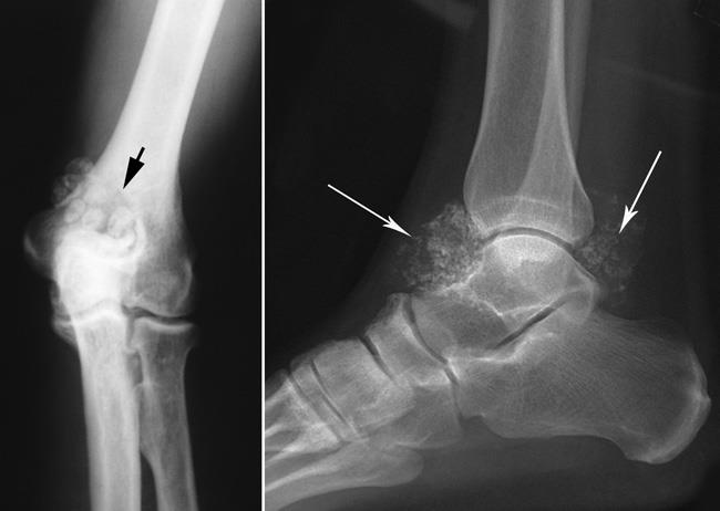 x-rays of synovial chondromatosis in elbow and ankle