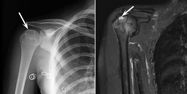 (Izquierda) La radiografía muestra un condroblastoma en el extremo superior del húmero (hueso de la parte superior del brazo).  Tenga en cuenta los bordes blancos que delimitan el tumor.  (Derecha) Una resonancia magnética del mismo tumor.