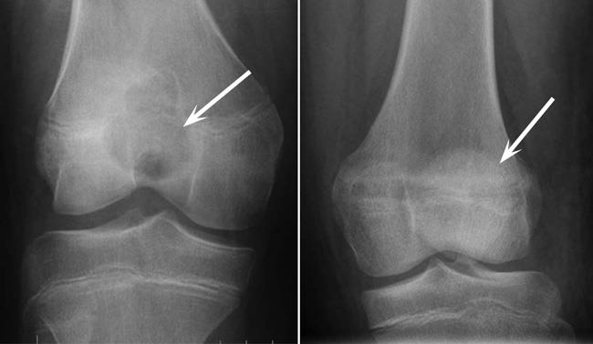 radiografía de condroblastoma antes y después del tratamiento