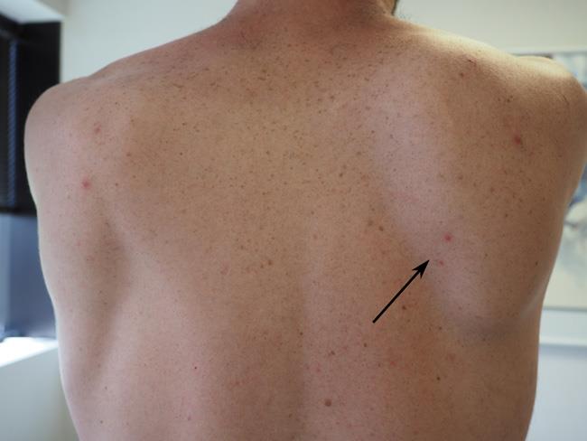 Shoulder Blade Pain Relief  5 Ways to Get Neck and Shoulder Blade