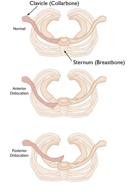 anterior and posterior sternoclavicular dislocation