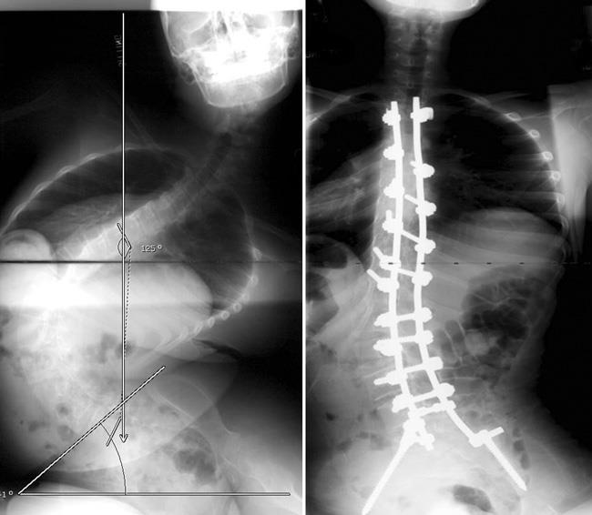 x-rays of large spinal curve and fusion