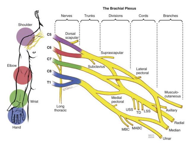 Lésion du plexus brachial