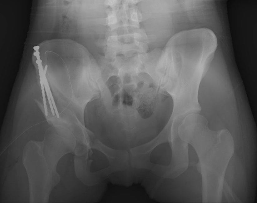 Hip replacement in young people