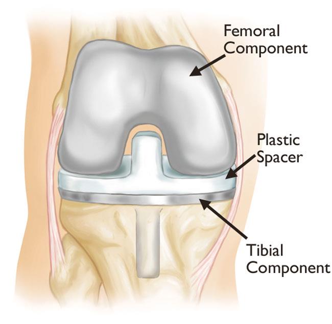 Solved] The contact between femoral and tibia components in knee joint