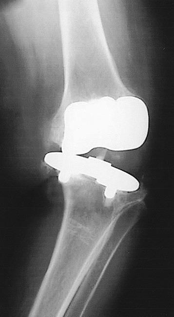 unstable knee implant