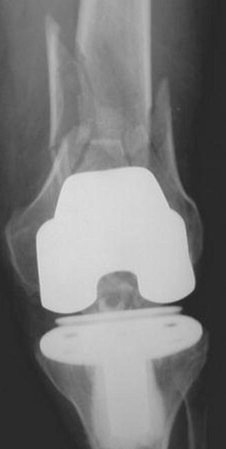 The femur (thighbone) has broken in several places around the implant. 