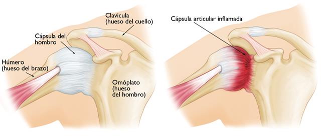 En el hombro congelado, los tejidos blandos de la cápsula del hombro se endurecen, se ponen rígidos y se inflaman. 