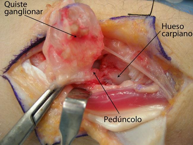 Un quiste ganglionar en la muñeca es removido durante una intervención quirúrgica llamada escisión. 
