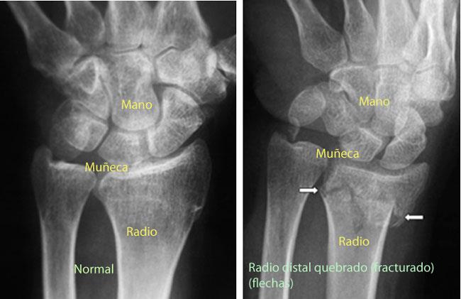 Fracturas del radio (muñeca quebrada) (Distal Fractures (Broken Wrist)) - OrthoInfo - AAOS