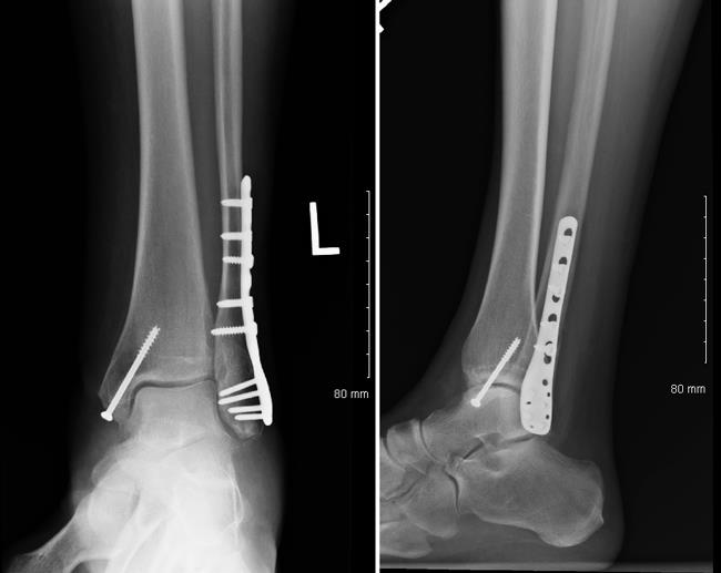 X-ray showing internal fixation of an ankle fracture