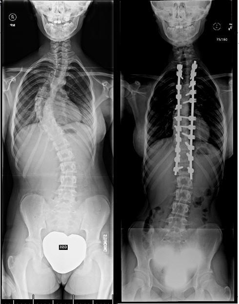 x-rays of scoliosis and surgical treatment