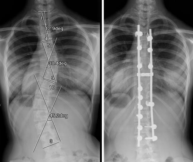 x-rays of scoliosis and fusion