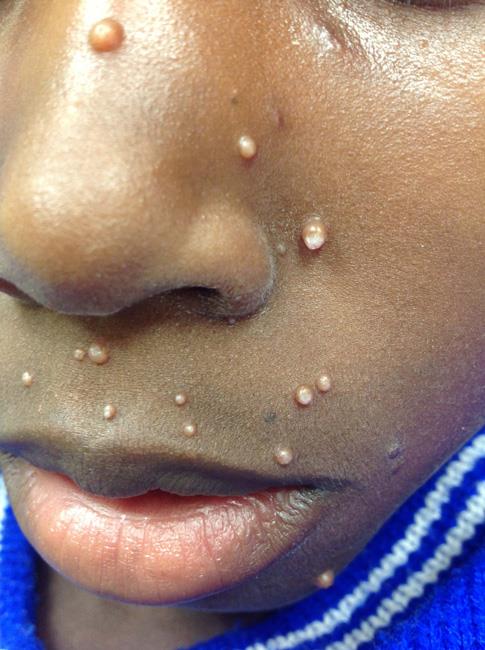 Molluscum contagiosum