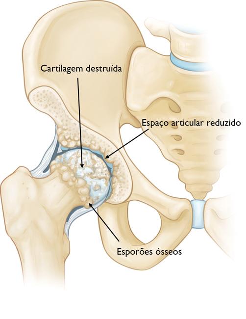 Quadril com osteoartrite. 