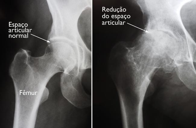 Artroplastia total de quadril (Total Hip Replacement) - OrthoInfo - AAOS