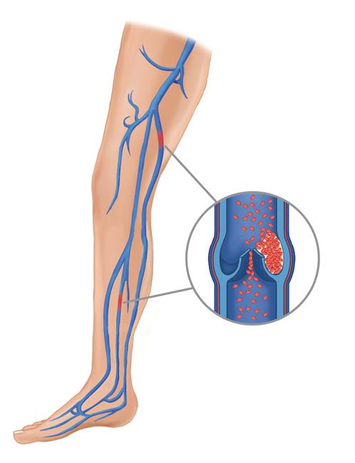 Pode haver formação de coágulos sanguíneos nas veias da perna ou da pelve. 