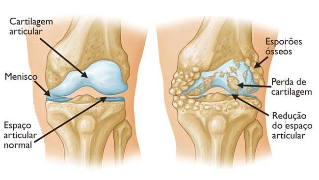 A osteoartrose resulta frequentemente no atrito entre os ossos. Esporões ósseos são uma manifestação comum dessa forma de artrite. 