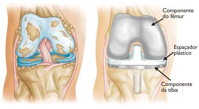 (Esquerda) Osteoartrose grave. (Direita) Cartilagem desgastada e osso subjacente retirados; fêmur e tíbia cobertos com implantes metálicos. Um espaçador plástico foi colocado entre os implantes. O componente patelar não é mostrado para facilitar a visualização. 