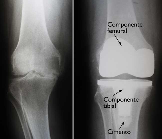 (Esquerda) Radiografia de um joelho com artrose grave. (Direita) Aspecto de uma artroplastia total de joelho na radiografia. Observe que o espaçador plástico inserido entre os componentes não aparece na radiografia. 