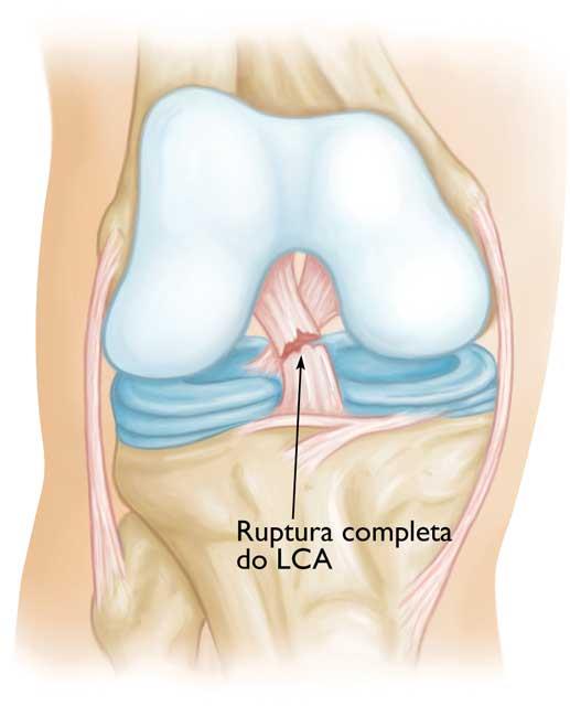 Rupturas parciais do ligamento cruzado anterior são raras, na maioria das lesões do LCA ocorre ruptura total ou praticamente total. 