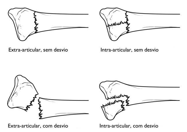 A ilustração mostra alguns dos tipos de fraturas distais do rádio. 