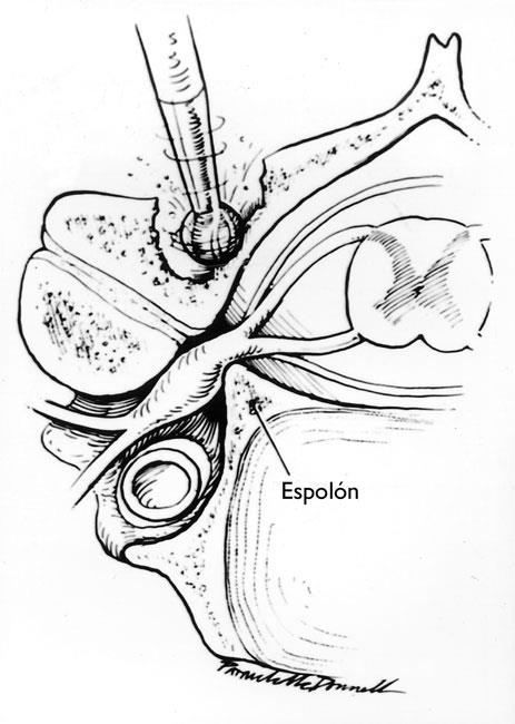 En la laminoforaminotomía cervical posterior, el médico usa instrumentos especializados para adelgazar la lámina y tener mejor acceso al nervio. 