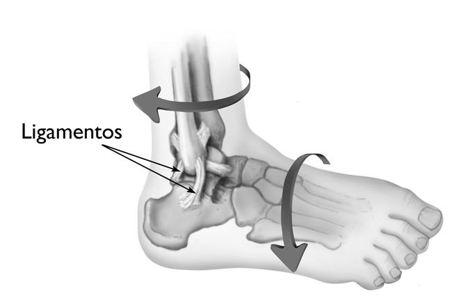 Una fuerza giratoria en la parte inferior de la pierna o pie es una causa común de los esguinces de tobillo. 