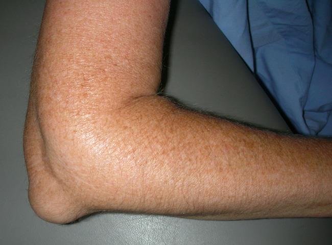 Inflamación asociada con bursitis del codo. 