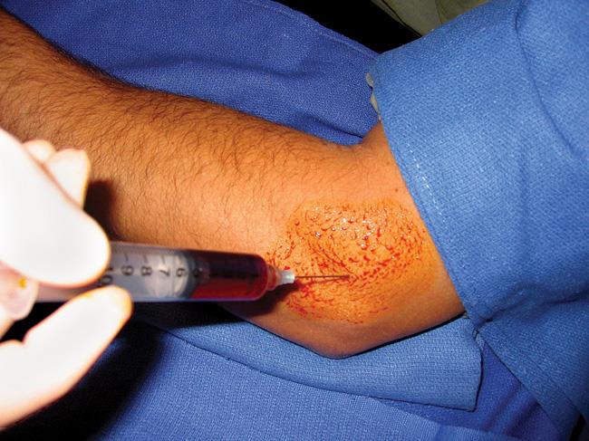 Una inyección de PRP se utiliza para tratar el codo de tenista. 