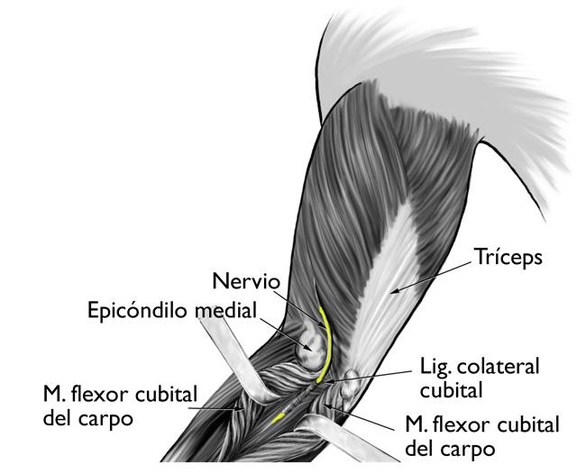 Esta ilustración muestra la ruta del nervio cubital a través del túnel cubital. También se muestran las estructuras que pueden comprimir el nervio, como el epicóndilo medial y el ligamento colateral cubital. 