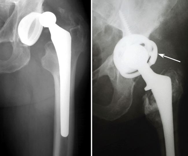 X-ray of dislocation after hip replacement 