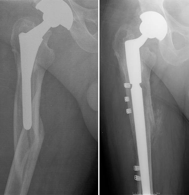 Revision surgery for periprosthetic fracture of the femur