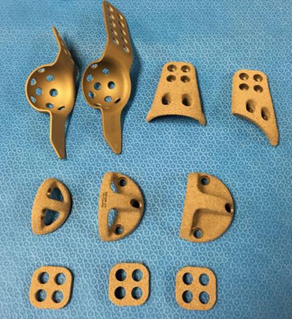Metal augments used in revision hip replacement