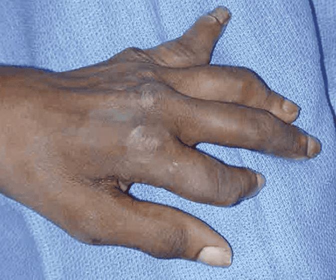 Fingers With Arthritis