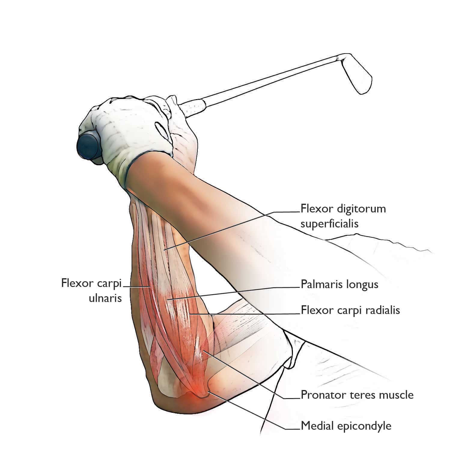 Illustration Showing Location of Medial Epicondylitis
