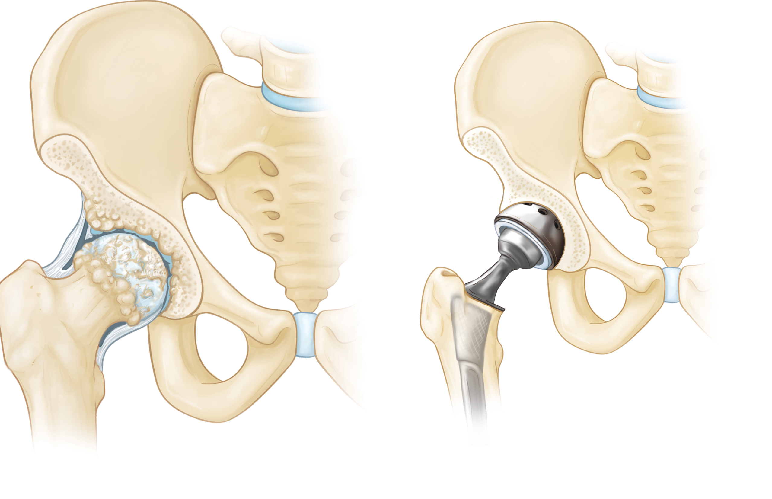 ip with osteoarthritis and hip with hip implant