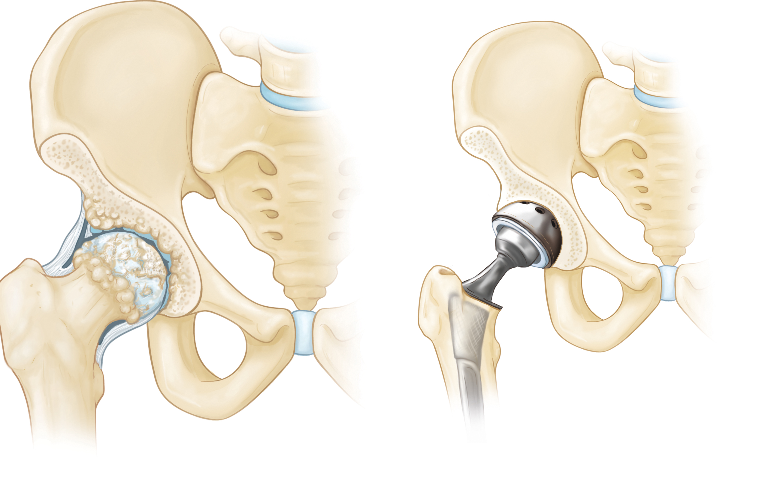 Physical therapy after hip replacement: Can rehab happen at home