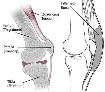Normal knee anatomy including the bursa involved in prepatellar bursitis