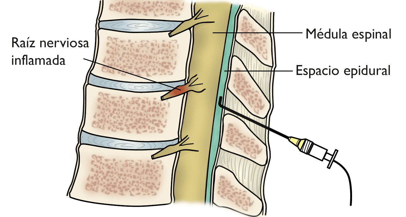 Dolor cervical: causas y tratamiento