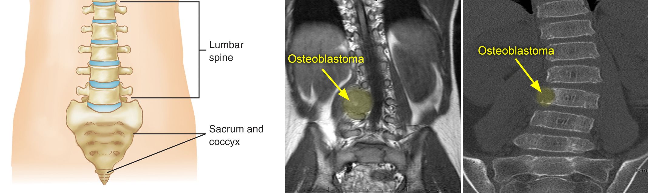 osteoblastoma that caused spinal curve