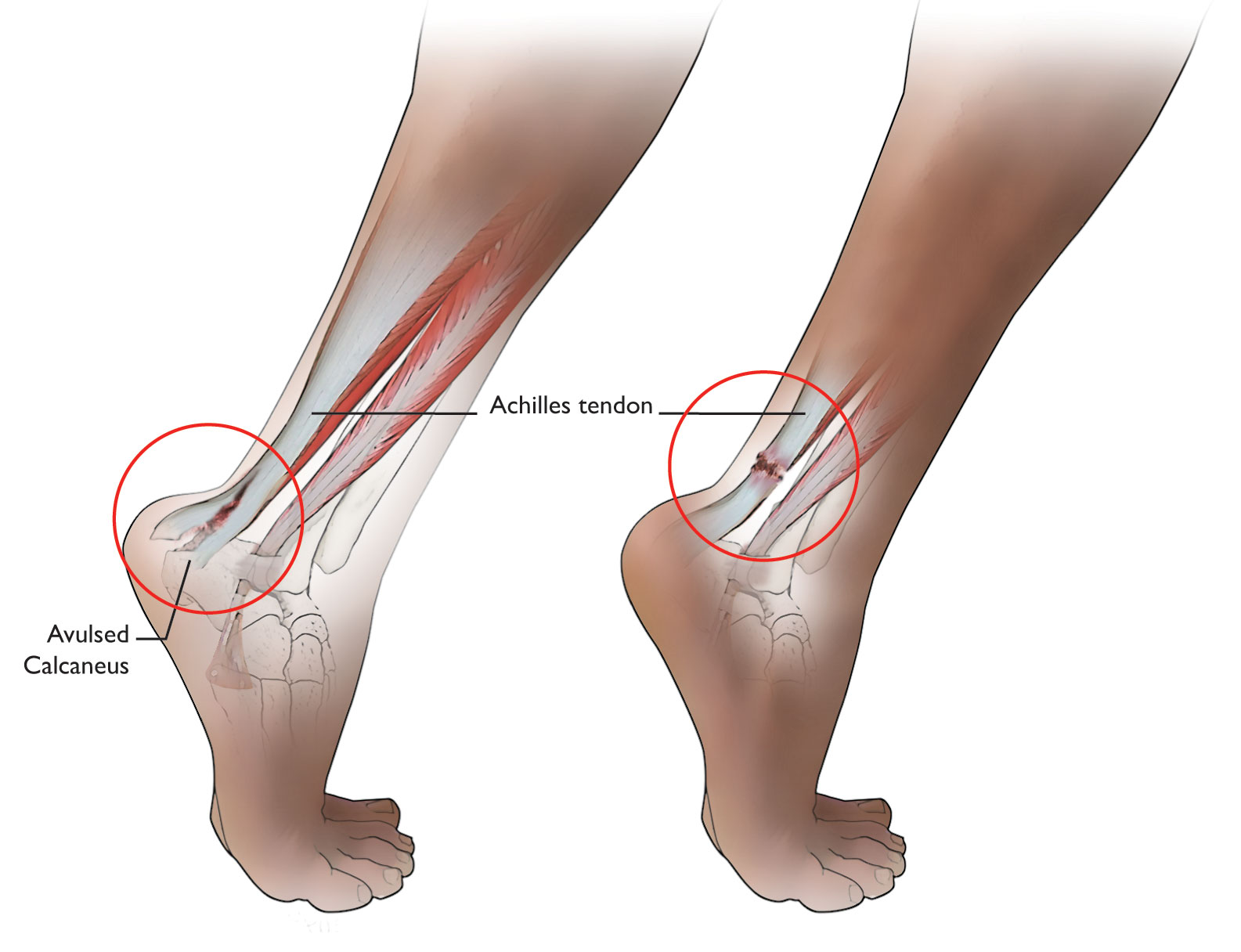 Illustration Showing Types of Complete Achilles Tendon Tears