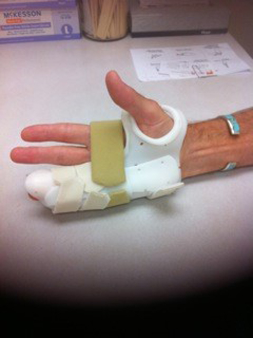 Splinting