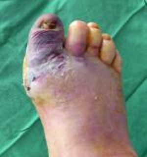 Swollen Feet from Diabetes: Causes and Treatment Options - Diabetes Strong