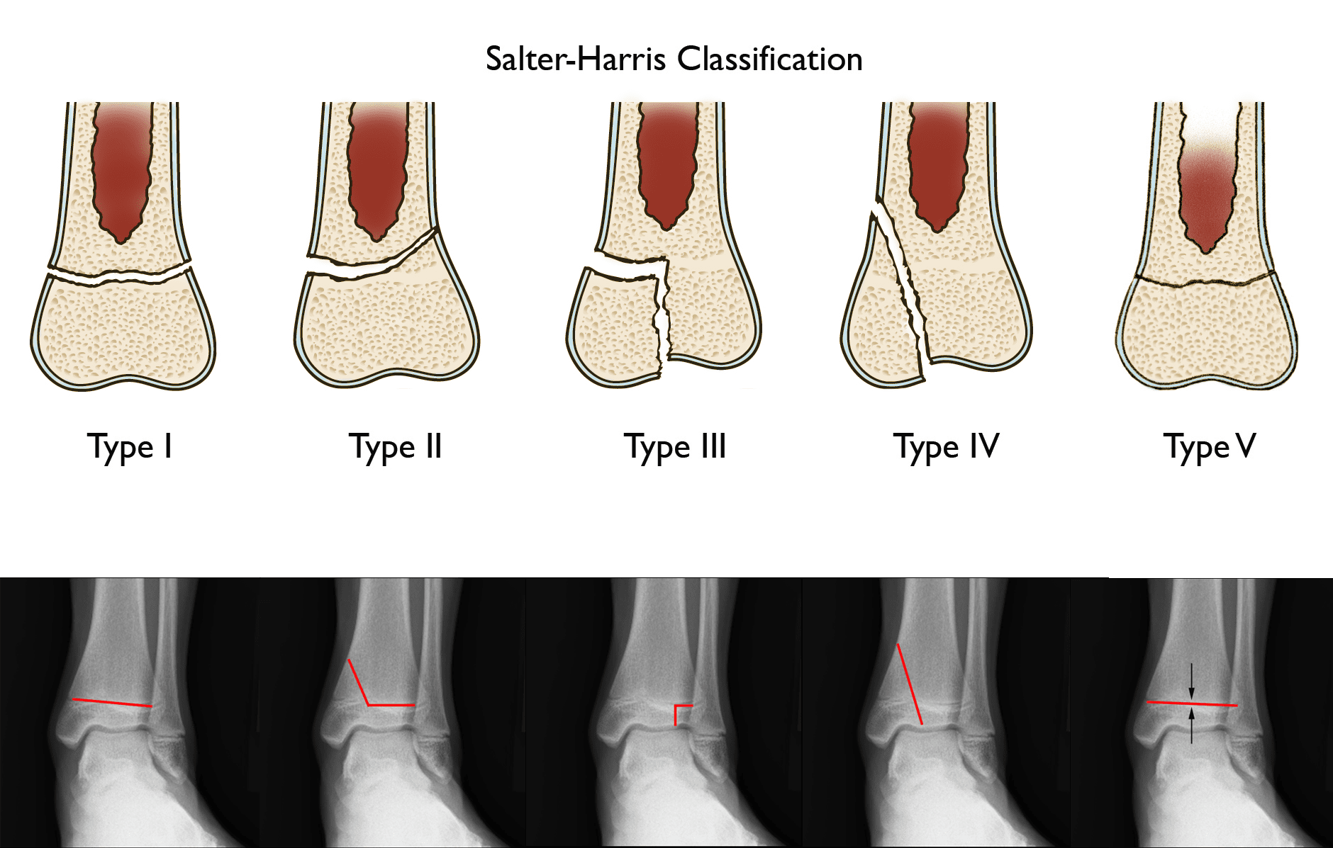 Ankle Fractures In Children Orthoinfo Aaos