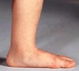 Pediatric - Flexible Flatfoot, Foot & Ankle