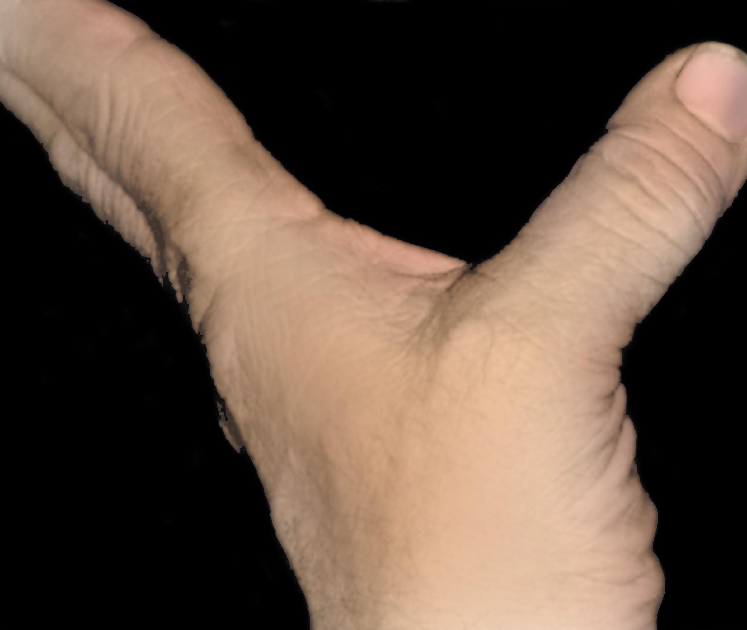 Photo of unstable thumb