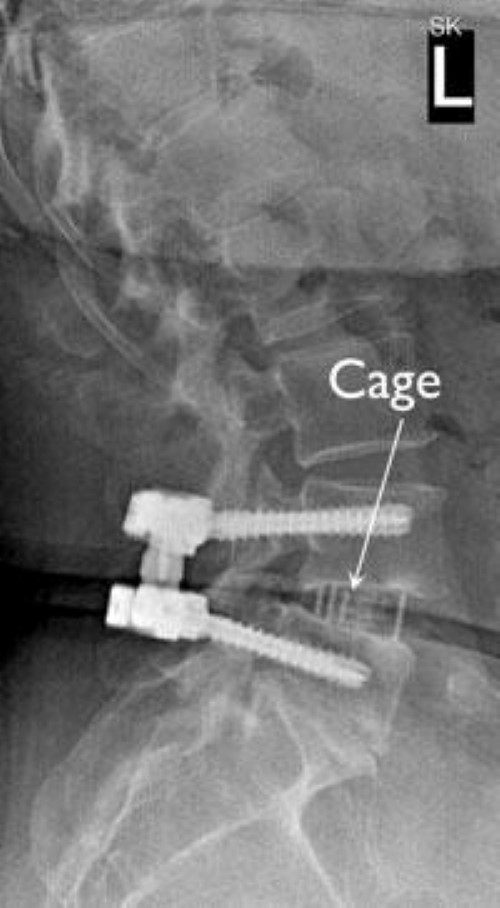 Spinal Fusion Lateral Lumbar Interbody Fusion Orthoinfo Aaos